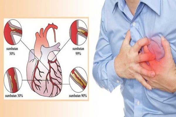 Penyakit Jantung Koroner Sembuh Dengan Bioenergi (Testimoni Ibu Siti Fatmawati)